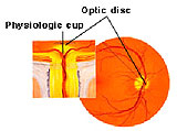 ГЛАУКОМА - Рисунок №1. Головка зрительного нерва (ГЗН) - место приложение патологических изменений при глаукоме