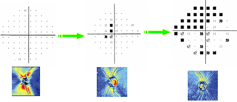 Диагностика ГЛАУКОМЫ - Рисунок №7. Динамика потери поля зрения у больного с глаукомой